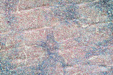 100x 血癌脾脏病组织宏观病理癌症药品放大镜科学细胞组织学蓝色图片