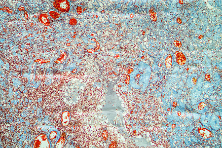 血浆瘤皮肤癌 100x药品皮肤增殖肉瘤癌症蓝色疾病科学细胞病理图片