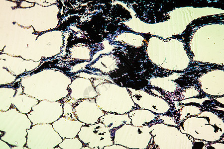 炭粉肺病组织 100x黑色药品科学协会尘肺煤尘肺义务宏观报告组织学图片