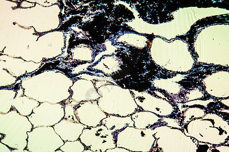 炭粉肺病组织 100x黑色药品科学协会尘肺煤尘肺义务宏观报告组织学图片