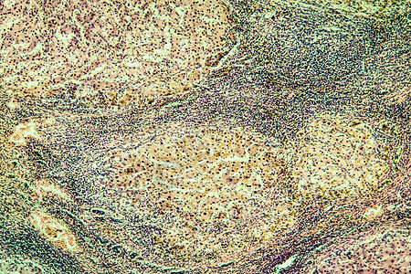 酒精滥用后 肝硬化组织感染了100x疾病科学显微术病理细胞药品宏观背景图片
