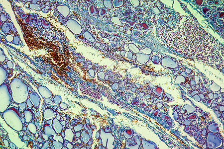 100x 甲状腺有科类甲状腺疾病组织学组织病理科学细胞薄片放大镜宏观胶体红色图片