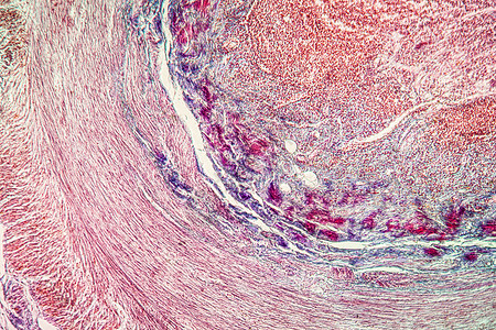 Appeneditic炎炎症 疾病组织 100x细菌盲肠科学细胞红色宏观薄片放大镜组织学附录图片