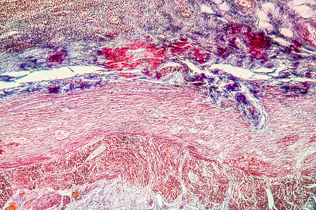 Appeneditic炎炎症 疾病组织 100x病理附录放大镜红色细菌细胞组织学科学药品宏观图片