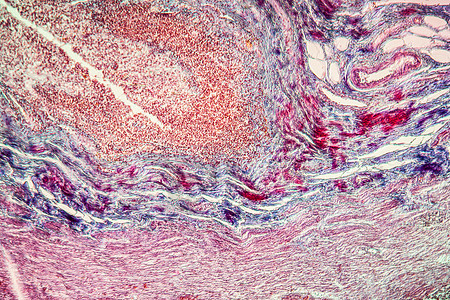 Appeneditic炎炎症 疾病组织 100x细菌组织学红色科学附录宏观薄片盲肠放大镜病理图片