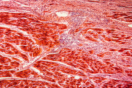 100x 卵巢组织细胞疾病宏观病理学病理腐烂药品放大镜囊肿红色薄片图片
