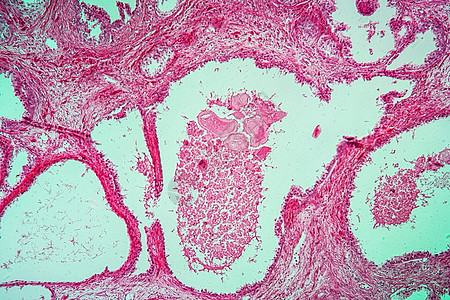 100x 前列腺膨胀疾病组织器官放大镜组织学增殖生殖器官病理分泌薄片宏观科学图片