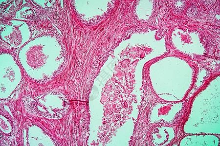 100x 前列腺膨胀疾病组织细胞病理生殖器官腺体宏观药品分泌放大镜科学增殖图片