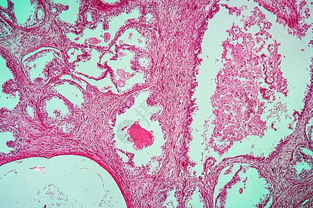 100x 前列腺膨胀疾病组织生殖器官器官放大镜腺体病理红色科学组织学薄片药品图片