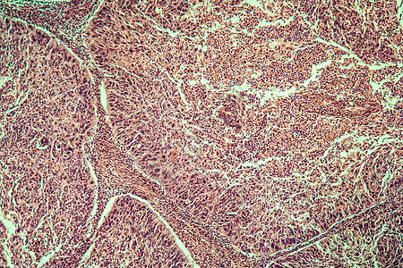 100x 子宫癌疾病组织红色显微术子宫病理妇科水仙癌症细胞宏观科学图片