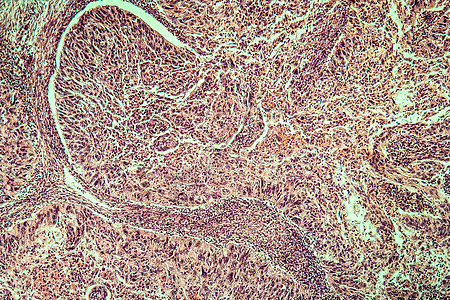 100x 子宫癌疾病组织药品组织学子宫结核显微术薄片癌症细胞病理放大镜图片