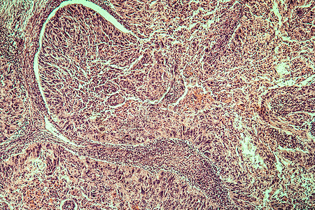 100x 子宫癌疾病组织药品组织学子宫结核显微术薄片癌症细胞病理放大镜图片
