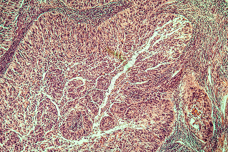 100x 子宫癌疾病组织细胞放大镜妇科薄片癌症红色病理科学显微术组织学图片