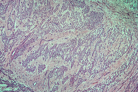 100x 子宫疾病组织细胞瘤女性组织红色宏观生长腐烂疾病科学妇科病理图片