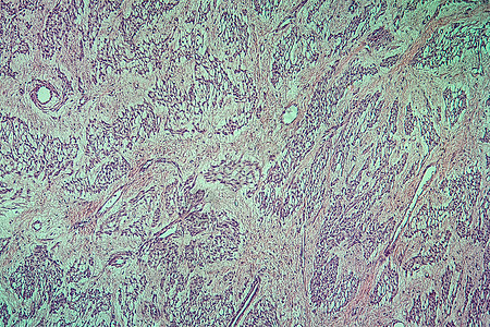 100x 子宫疾病组织细胞瘤放大镜科学组织女性细胞子宫疾病妇科宏观薄片图片
