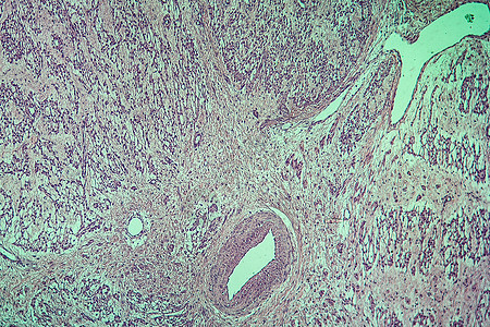 100x 子宫疾病组织细胞瘤生长疾病放大镜科学红色组织女性组织学宏观子宫图片