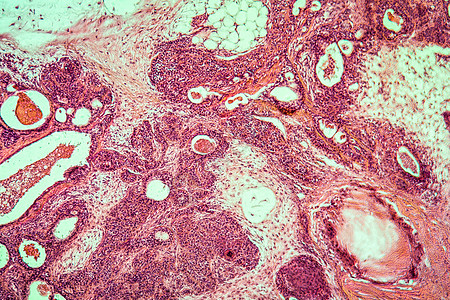 帕罗蒂斯人疾病组织100x病理腮腺药品疾病组织癌症红色结核科学宏观图片