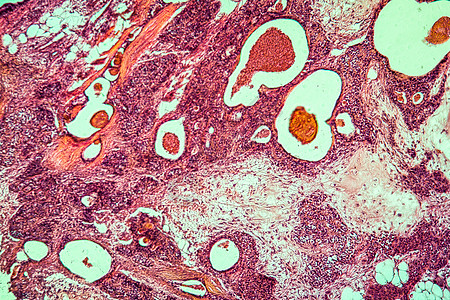 帕罗蒂斯人疾病组织100x腮腺药品病理红色疾病薄片结核宏观癌症放大镜图片