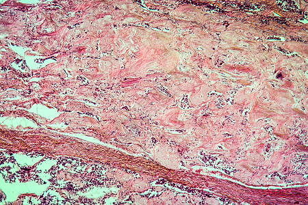 甲状腺疾病组织100x的混合肿瘤病理放大镜薄片科学组织学腺体增殖红色癌症药品图片