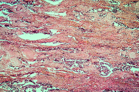 甲状腺疾病组织100x的混合肿瘤腐烂宏观薄片细胞放大镜增殖癌症药品病理红色图片