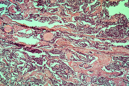 甲状腺疾病组织100x的混合肿瘤细胞癌症放大镜腐烂薄片增殖红色腺体药品组织学图片