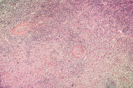 淋巴腺癌 疾病组织 100x摄影癌症病理科学淋巴瘤腺体肉瘤红色药品薄片图片
