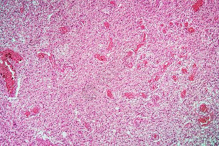 100x 患病组织Glioma肿瘤生长病理结核红色腐烂细胞科学疾病癌症组织学图片