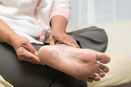 高龄女子脚上皮肤干燥和角膜脚跟保健划痕静脉糖尿病指甲裂缝卫生伤害赤脚图片