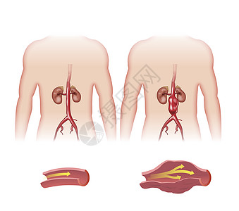 动脉血管损害腹部心脏病外科心脏压力主动脉流动胸部背景图片