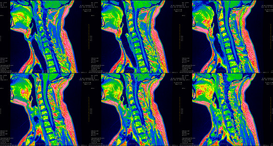 一套6个剖面绿色彩色MRI扫描仪 对C6C7片段双边半中间体延伸的34岁大白鲸男性颈部区域进行检查电脑照相保健椎骨飞机解剖学考试图片