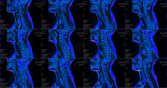 脊柱医疗一套12个剖面蓝色彩色MRI扫描仪 对C6-C7片段双边半中间体延伸的34岁大白鲸男性颈部区域进行检查背景
