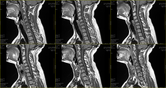 6次剖面核磁共振仪扫描 对34岁大白鲸男性的颈部区域进行6次直射式MRI扫描 在C6-C7段用放射病进行双边准中间介质挤压图片