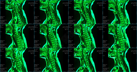 一套6个剖面绿色彩色MRI扫描仪 对C6C7片段双边半中间体延伸的34岁大白鲸男性颈部区域进行检查医院保健飞机脊柱射线疾病椎骨成图片