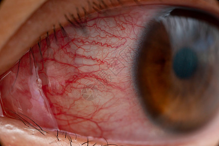特写刺激或受感染的红血球眼睛结膜眼球视网膜医生静脉眼科花粉细菌血丝药品宏观图片
