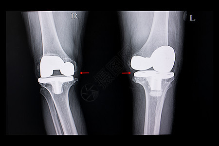 双膝节肢炎的X光胶片图片