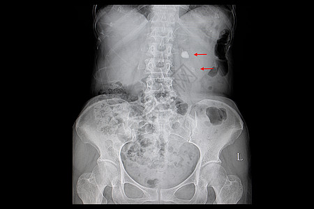 右肾上一块大石头的X光胶片图片