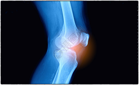 对腿骨折病人进行X光检查图片