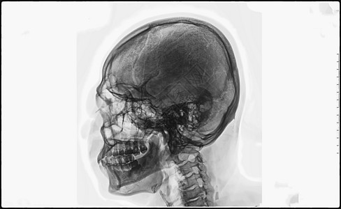 胶片X光头骨和宫颈脊椎横向视图 从鼻子到胸部的人体骨骼X光膜疼痛科学教育考试药品解剖学医生骨科医院射线图片