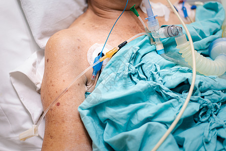 病人在医院做气管切除术和呼吸器管子职业药品科学护理乐器呼吸单元从业者女性图片