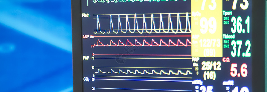 监测病人的病情和生命迹象 在医院 特别护理中配备监视器计划展示生活电脑诊所技术外科医疗监护疾病图片
