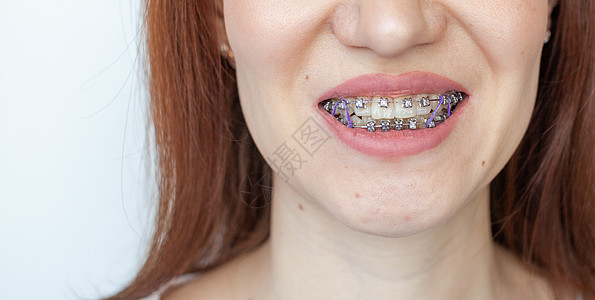 女孩微笑的嘴里有护身符 牙套上滑动的牙齿卫生矫正搪瓷牙科松紧带技术金属刷子牙医医生图片