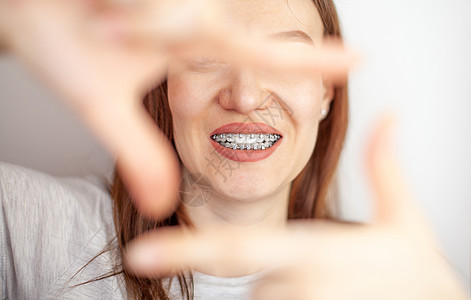 一个白牙上有牙套的女孩 手握着一副框架牙齿系统金属刷子女士搪瓷嘴唇牙医口腔科压力图片