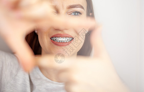 一个白牙上有牙套的女孩 手握着一副框架嘴唇女士医生牙齿女性矫正治疗技术口腔科牙医图片