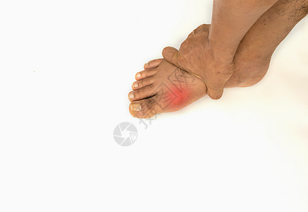 脚病风湿和痛风痛苦风湿病伤害手指病人过滤疾病保健皮肤脚趾图片