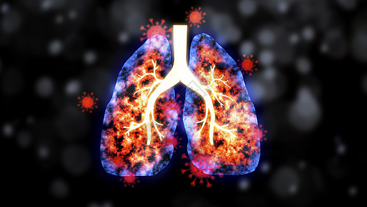 肺感染 冠状病毒图片