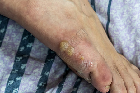 西洋参泡水徒步多泡水器治疗医疗水疱男人脚趾湿疹赤脚伤口伤害感染背景