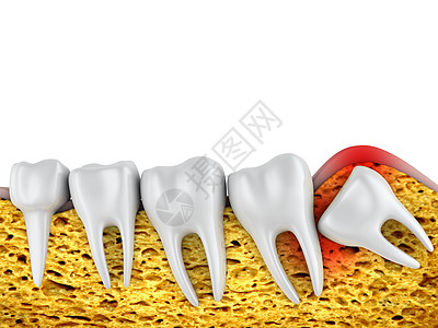 磨牙和智齿嵌塞白色牙齿外科凹痕插图疾病牙疼损害疼痛图片