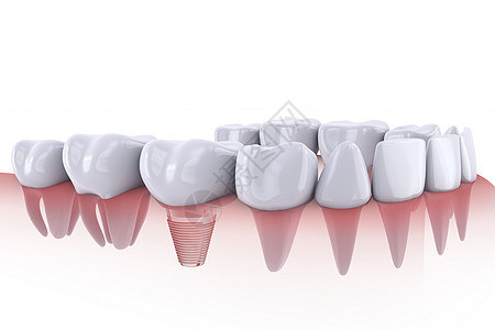 植入和植入牙齿假牙搪瓷骨科磨牙植入物药品医生凹痕牙医技术图片