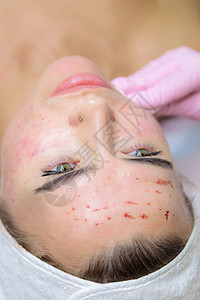 一名年轻女性脸上注射血浆的血迹被抹去 笑声美丽治疗皮肤沙龙程序清洁眼睛女孩奶油化妆师图片