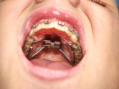 带固定牙套的嘴巴 口腔正畸方法乐器咀嚼牙齿手套男生塑料塑料盖牙医矫正医生图片